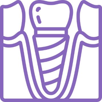 Implantes dentista Alcoy