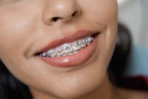 beneficios de los brackets Damon