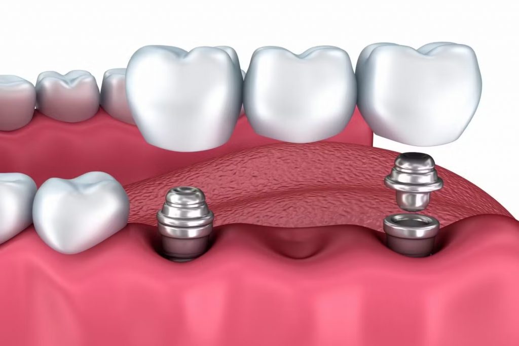 Implantes dentales, implantes con tornillo, tipos de implantes dentales