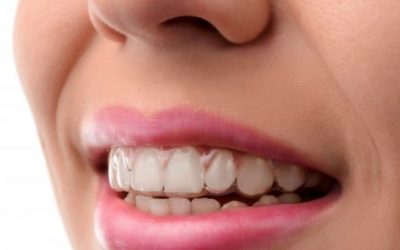 Qué es la ortodoncia invisible y sus tipos