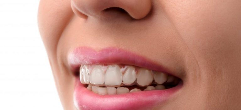 Qué es la ortodoncia invisible y sus tipos