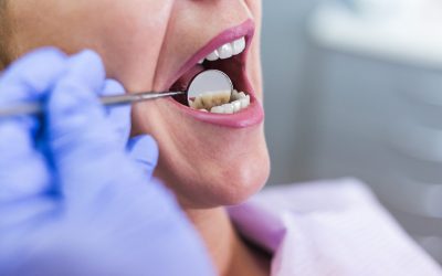 Infección dental: Síntomas y tratamientos
