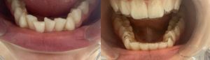 ortodoncia invisible antes y despues 9