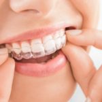 Cuanto cuesta la ortodoncia invisible