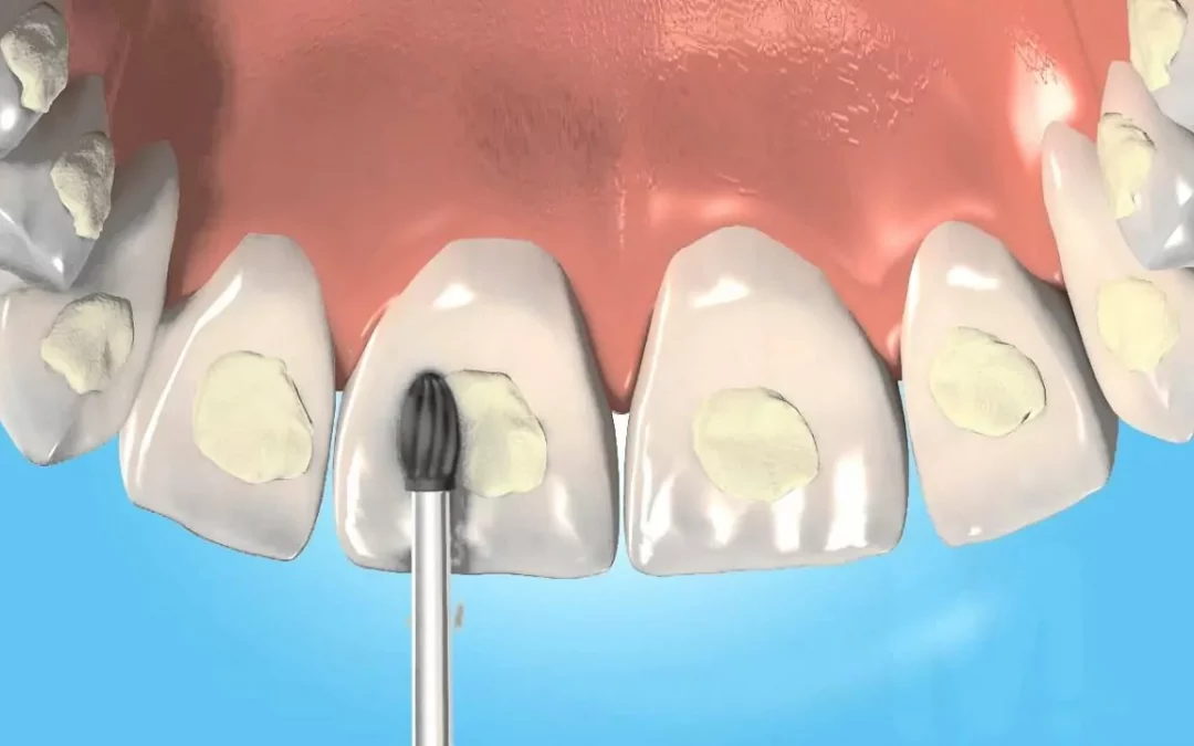 Resinas dentales ¿Qué es una adhesión compuesta dental?