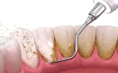 Qué es la limpieza dental: descripción general, beneficios y resultados esperados