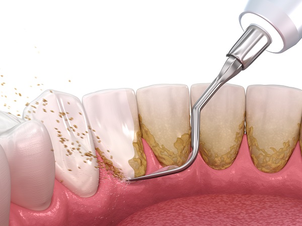 Qué es la limpieza dental: descripción general, beneficios y resultados esperados