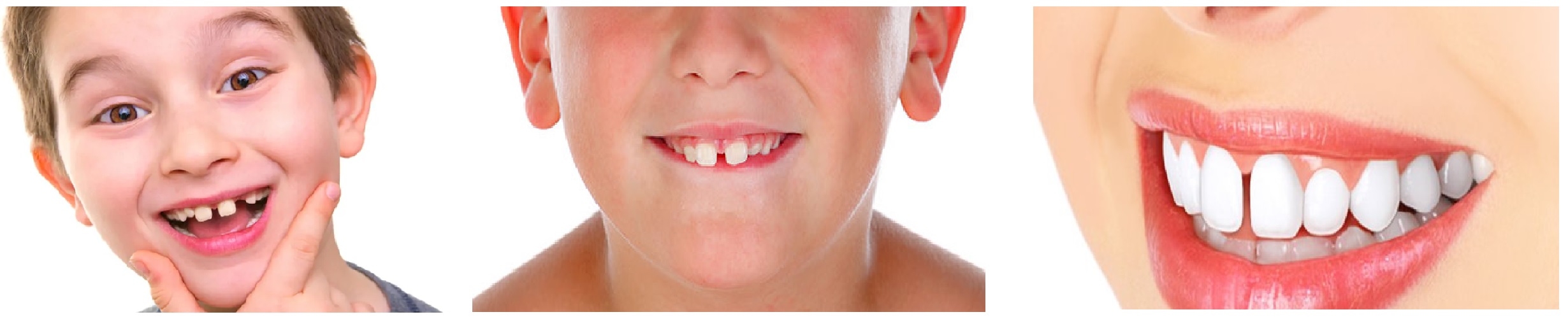 separacion entre dientes diastema