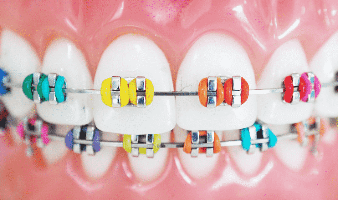 Color de brackets para que los dientes se vean blancos