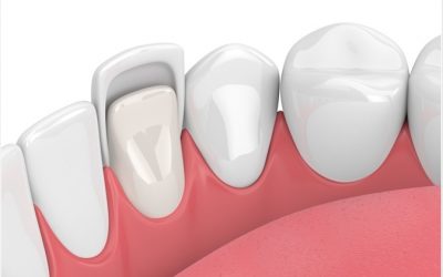 Carillas dentales: 12 recomendaciones para su cuidado