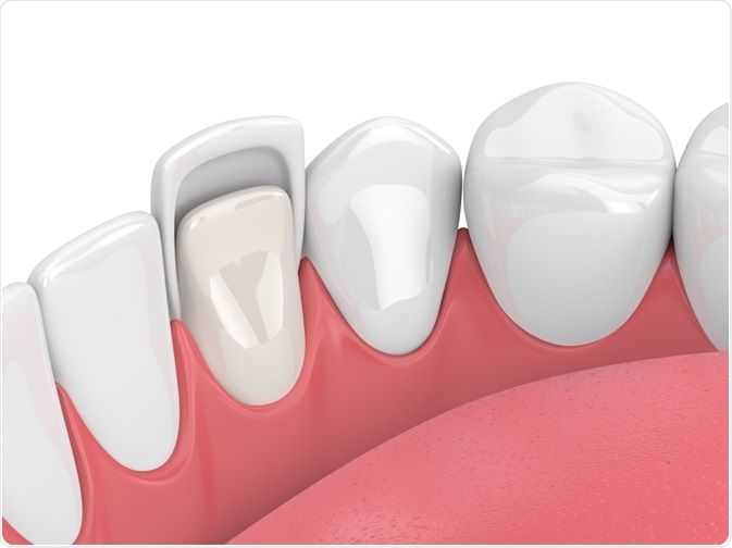 Carillas dentales: 12 recomendaciones para su cuidado