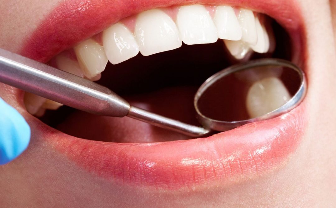 Ventajas y desventajas de las carillas dentales
