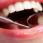 Beneficios y Que son las carillas dentales