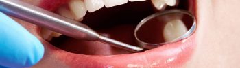 Beneficios y Que son las carillas dentales