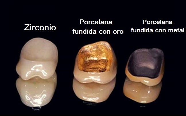 Corona Metal Porcelana sobre Implante