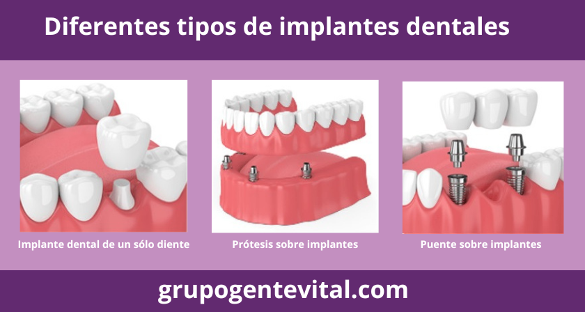 Diferentes_tipos_de_implantes Clinica dental en Alcoy
